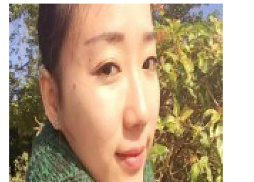 豐全臉手術(shù)  讓我膠原蛋白滿滿光彩照人 - 珍美網(wǎng)