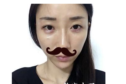 豐全臉手術(shù)  讓我膠原蛋白滿滿光彩照人 - 珍美網(wǎng)