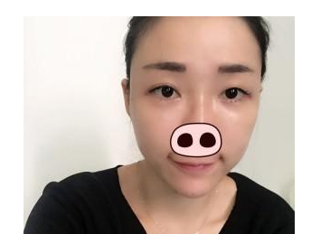 豐全臉手術(shù)  讓我膠原蛋白滿滿光彩照人 - 珍美網(wǎng)