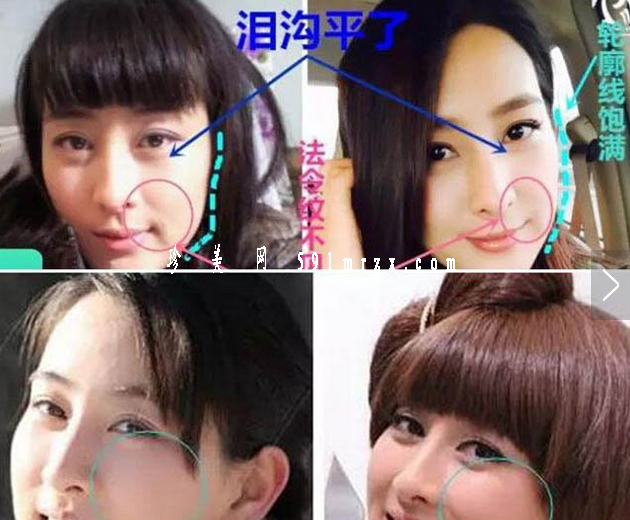 馬蘇有整容過(guò)嗎？看對(duì)比圖網(wǎng)友始終不愿相信 - 珍美網(wǎng)