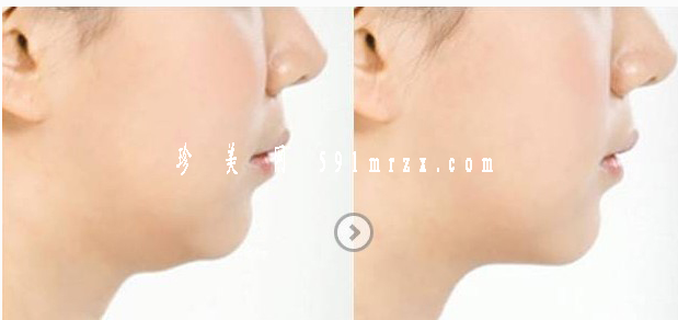 面部吸脂瘦臉多長(zhǎng)時(shí)間可以恢復(fù)正常呢