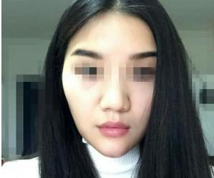 玻尿酸豐下巴 讓我擺脫短下巴的不美麗 - 珍美網(wǎng)