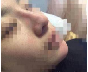玻尿酸隆鼻 塌鼻變高挺美鼻分分鐘美出境界 - 珍美網(wǎng)