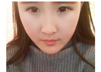 玻尿酸豐下巴   美麗的下巴讓我重獲自信 - 珍美網(wǎng)