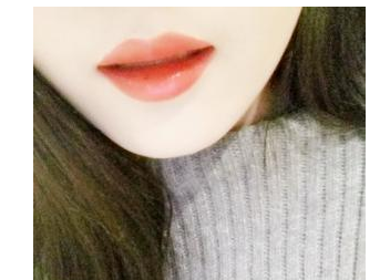 玻尿酸豐下巴   美麗的下巴讓我重獲自信 - 珍美網(wǎng)