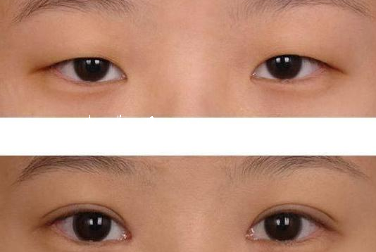 上眼臉下垂手術后恢復時間是多久