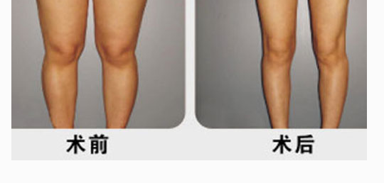 王新燦小腿吸脂效果好不好呢