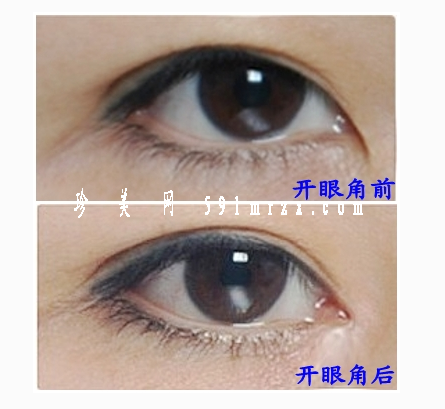 開眼角有沒有副作用呢