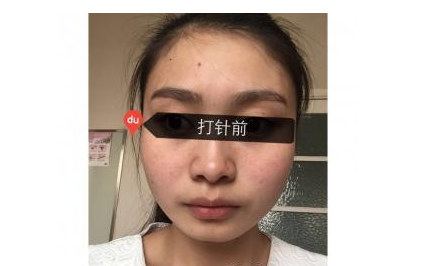 玻尿酸面部填充+瘦臉針 讓我的面貌更加精致美麗 - 珍美網(wǎng)