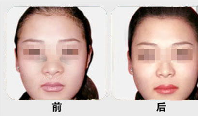 鼻翼縮小術(shù)效果怎么樣