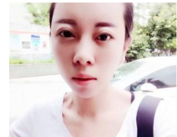 割雙眼皮手術(shù)  大眼睛真的好迷人啊 - 珍美網(wǎng)
