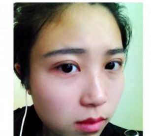 割雙眼皮手術(shù)  大眼睛真的好迷人啊 - 珍美網(wǎng)
