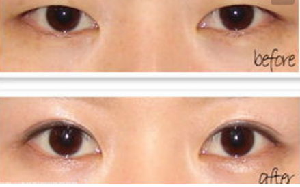雙眼皮手術(shù)效果怎么樣呢