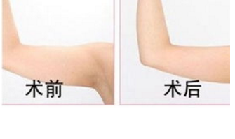 手臂吸脂手術(shù)效果好不好
