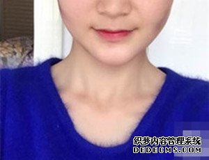 假體豐下巴對比照  輕松擁有俏麗下巴