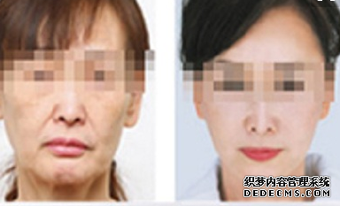 激光除皺手術(shù)多少錢