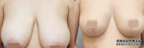 巨乳縮小手術(shù)效果好不好