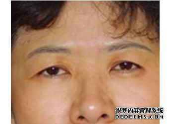 肉毒素去眉間紋 年輕的感覺真開心