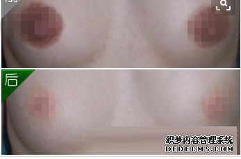 乳暈縮小手術(shù)對(duì)比照