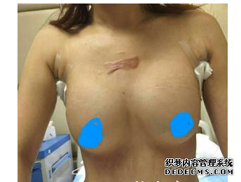 隆胸手術(shù) 胸變大 我的自信也找回來了