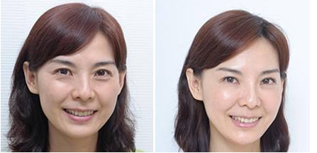 激光除皺手術優(yōu)勢有哪些呢