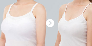 巨乳縮小手術(shù)有沒有后遺癥
