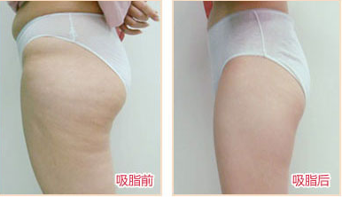 臀部吸脂手術(shù)對(duì)比照