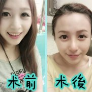 上海鼻綜合整形手術(shù)需要多少錢(qián)?