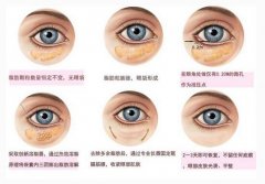 北京哪里有好的去眼袋專家？