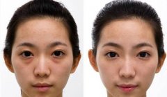 成都去眼袋有著什么樣的好方法？