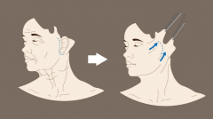 全臉拉皮手術(shù)會(huì)留疤痕嗎、價(jià)格是多少