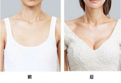 長沙隆胸自體脂肪需要多少錢？脂肪隆胸價格詳解