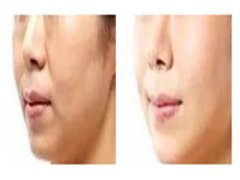 玻尿酸和水光針有什么不一樣？