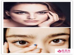 墊眉弓眼睛有什么變化_墊眉弓前后對比