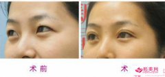 電眼雙眼皮恢復(fù)過(guò)程需注意的事項(xiàng)