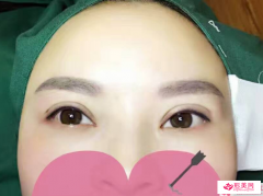 電眼雙眼皮第一天注意什么呢？