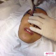點壓雙眼皮成型術(shù)有效的方法是什么呢？