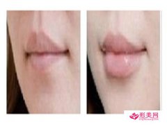 豐唇術(shù)_豐唇術(shù)如何讓嘴唇變的性感