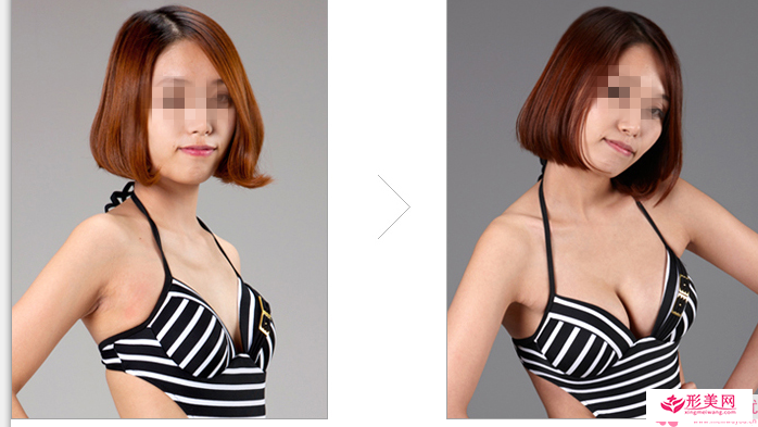texture假體隆胸要的費用多少呢