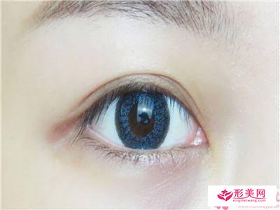 3點(diǎn)切開雙眼皮后的護(hù)理注意事項(xiàng)有哪些
