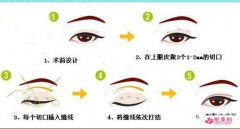 三點定位雙眼皮多久恢復？護理能縮短恢復時間嗎？