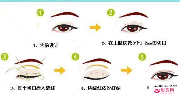 三點(diǎn)定位雙眼皮