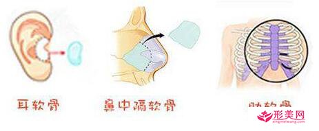 自體軟骨隆鼻用的是哪里的軟骨