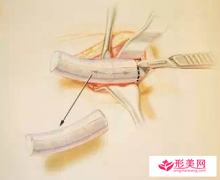 做自體軟骨隆鼻后多久能正常上班？