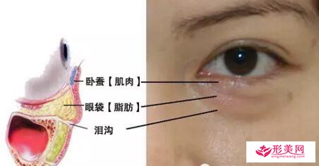 手術(shù)切除眼袋還會復(fù)發(fā)嗎