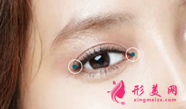 開眼角恢復(fù)期有疤痕出現(xiàn)怎么辦