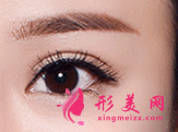 眼瞼下垂能做雙眼皮手術(shù)嗎