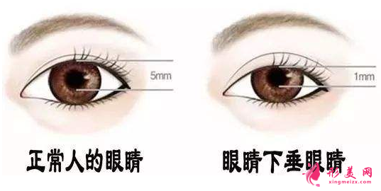 眼瞼下垂能做雙眼皮手術(shù)嗎