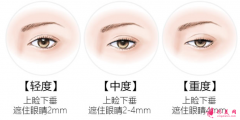 廣州美萊美容，上眼皮下垂有什么方法改善嗎?