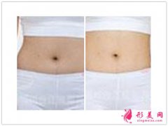 吸脂手術(shù)_吸脂手術(shù)有什么危害？
